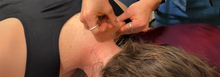 Acupuncture needles being carefully placed along the upper back in a treatment session.